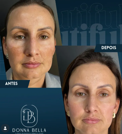 Resultado de Bioestimuladores de Colágeno