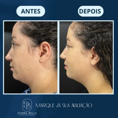 Resultado de Lipo de Papada