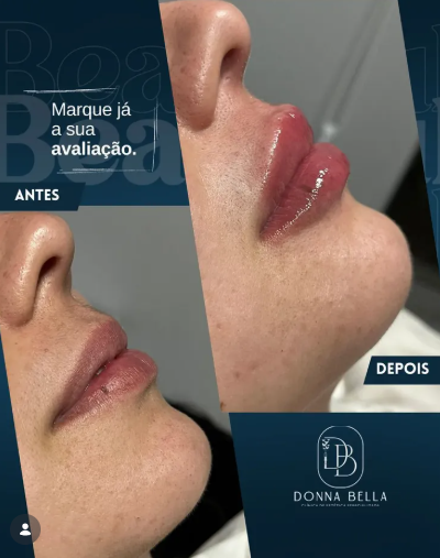 Resultado de Preenchimento Labial