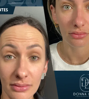 Resultado de Toxina Botulínica na Donna Bella