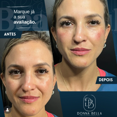 Resultado de Ultraformer facial